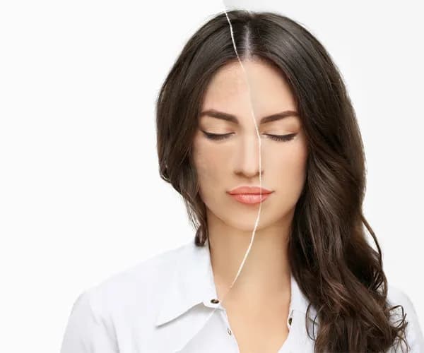 Hyperpigmentation Treatment Clinic in Delhi