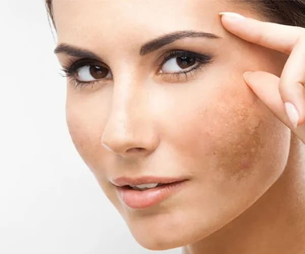 Melasma Treatment Clinic in Delhi