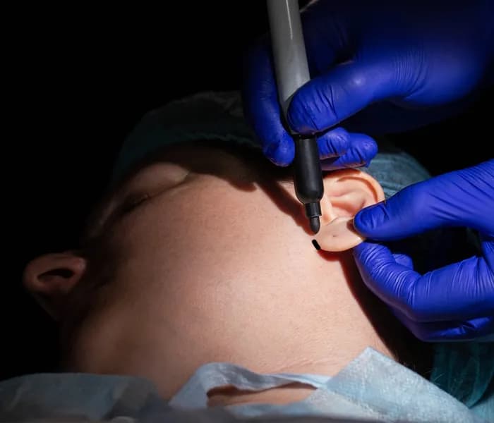 Ear Lobe Repair Surgery Treatment in Delhi, India