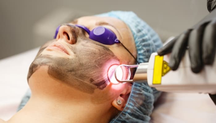 Best Pico Laser Treatment for Skin in Delhi