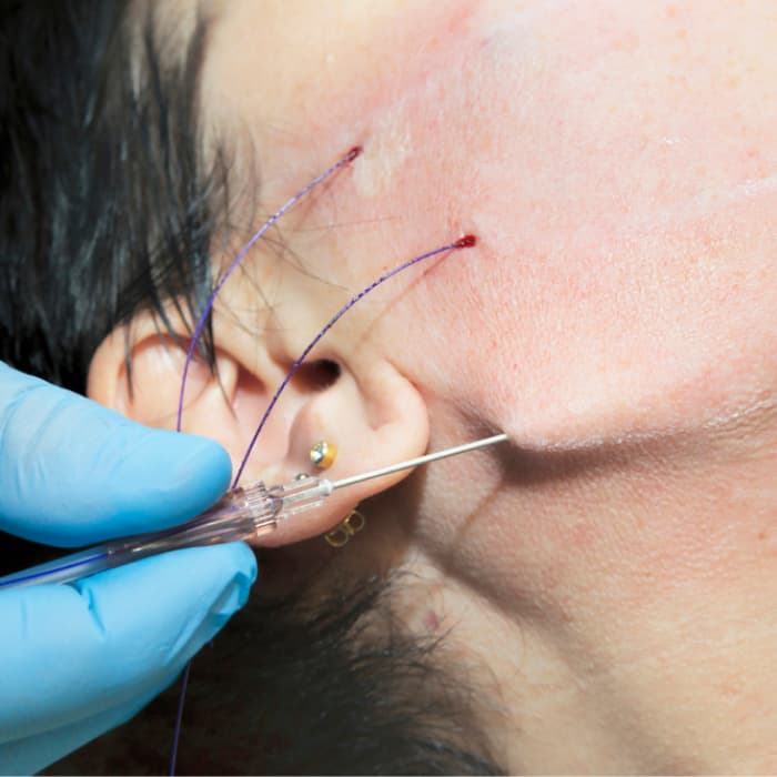 Thread Lift Treatment Clinic in Delhi