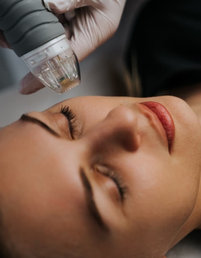 MNRF Microneedling for Acne Scars and Texture