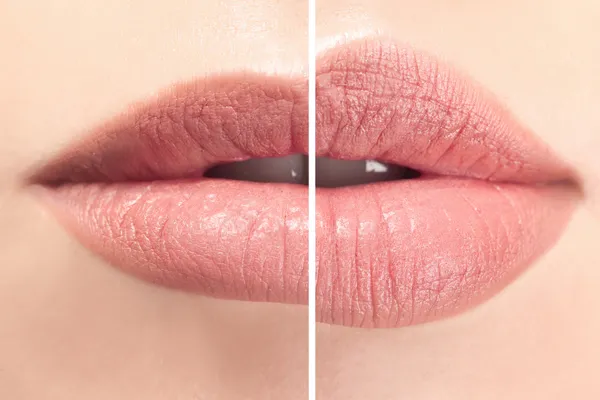 Lip SKIN REJUVENATION TREATMENT