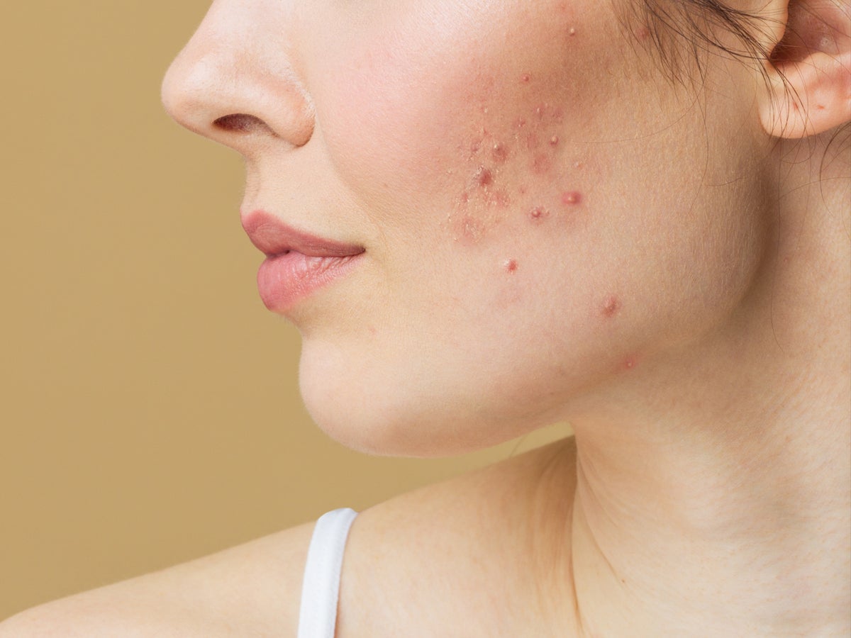 Acne treatment