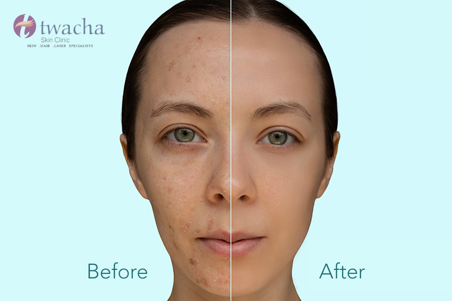 Best Chemical Peel for Acne Scars What Really Works