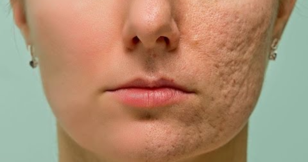 Chemical Peel for Acne Scars