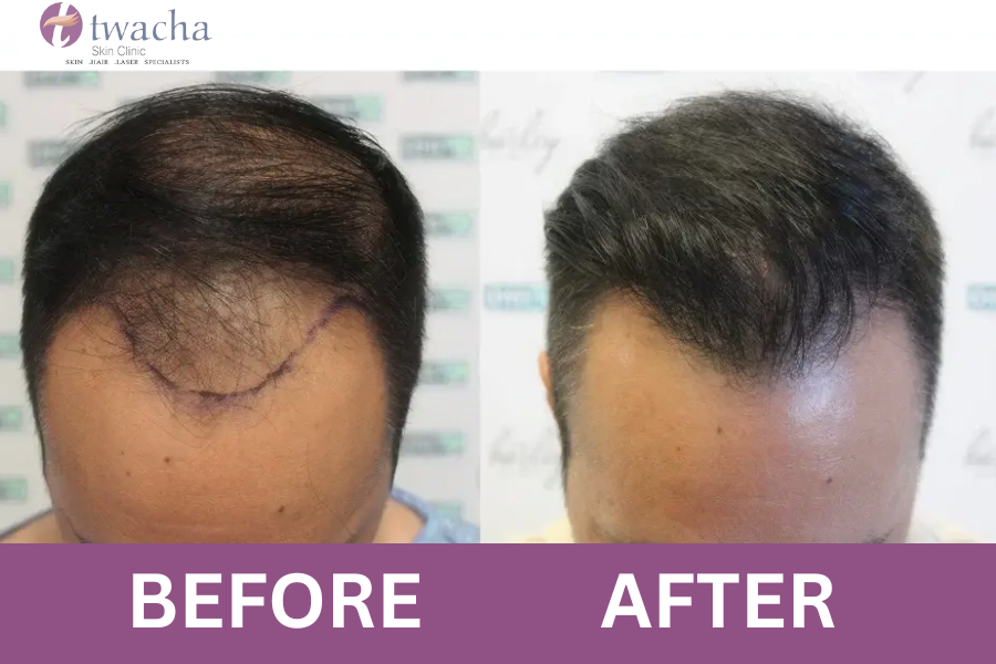 Hair Transplant Procedure: What to Expect Before & After