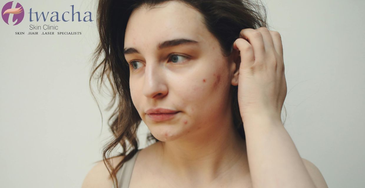 How to remove acne scars naturally in a week