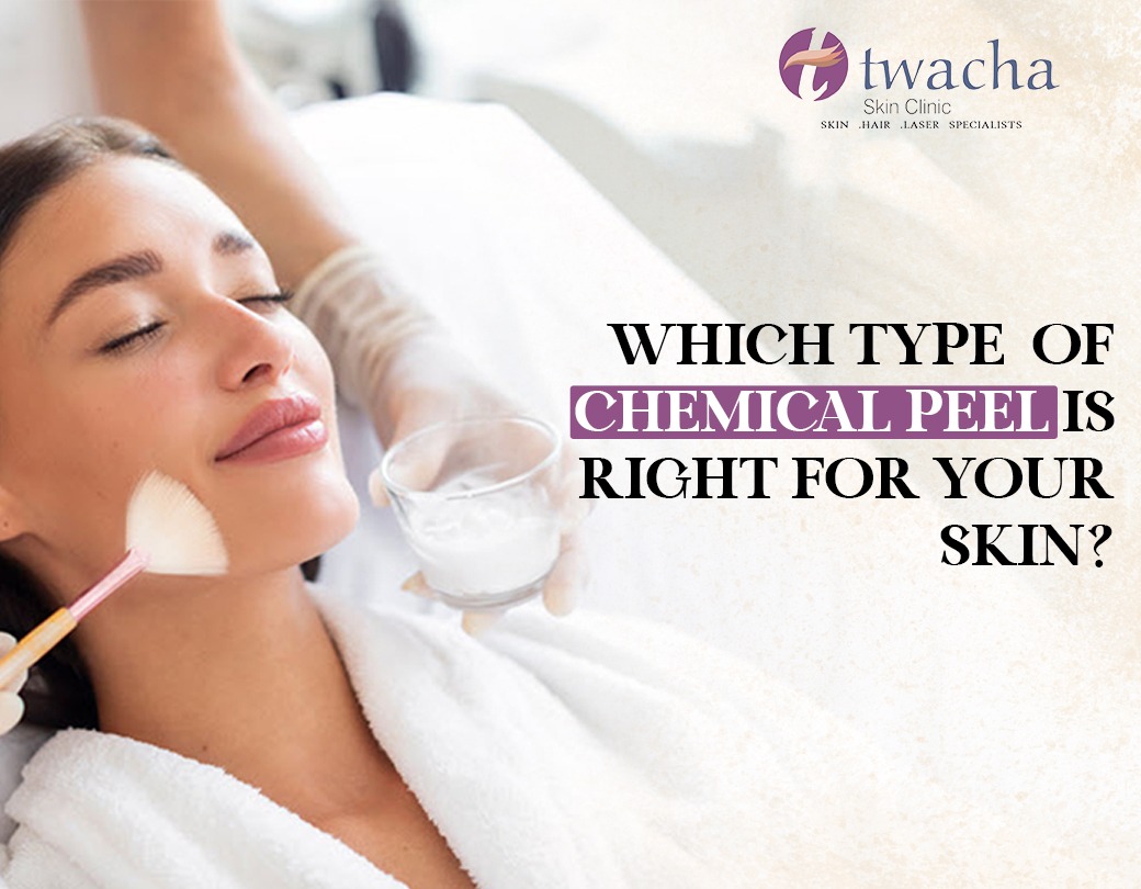 Which Type of Chemical Peel is Right for Your Skin?