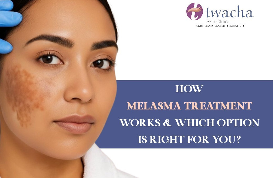 How Melasma Treatment Works & Which Option is Right for You?